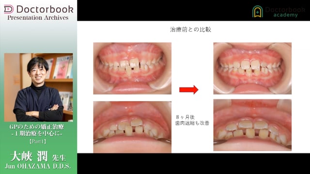 GPのための矯正治療 -Ⅰ期治療を中心に- | Doctorbook academy