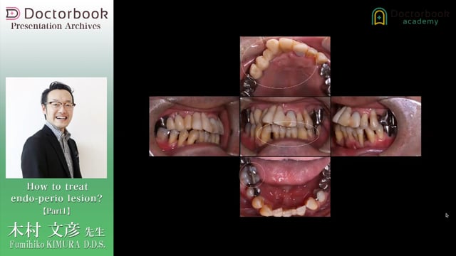 How to treat endo-perio lesion?