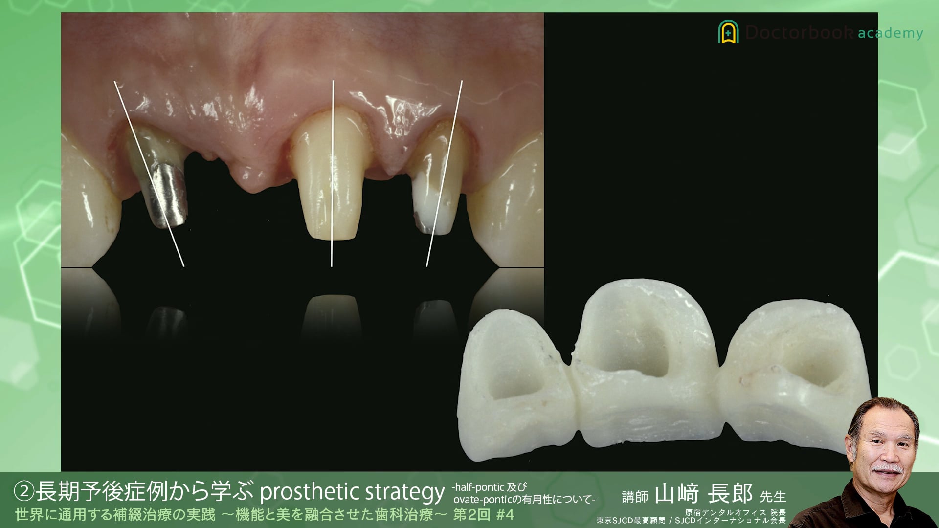 #4 長期予後症例から学ぶ prosthetic strategy -half-pontic 及び ovate-pontic の有用性について-