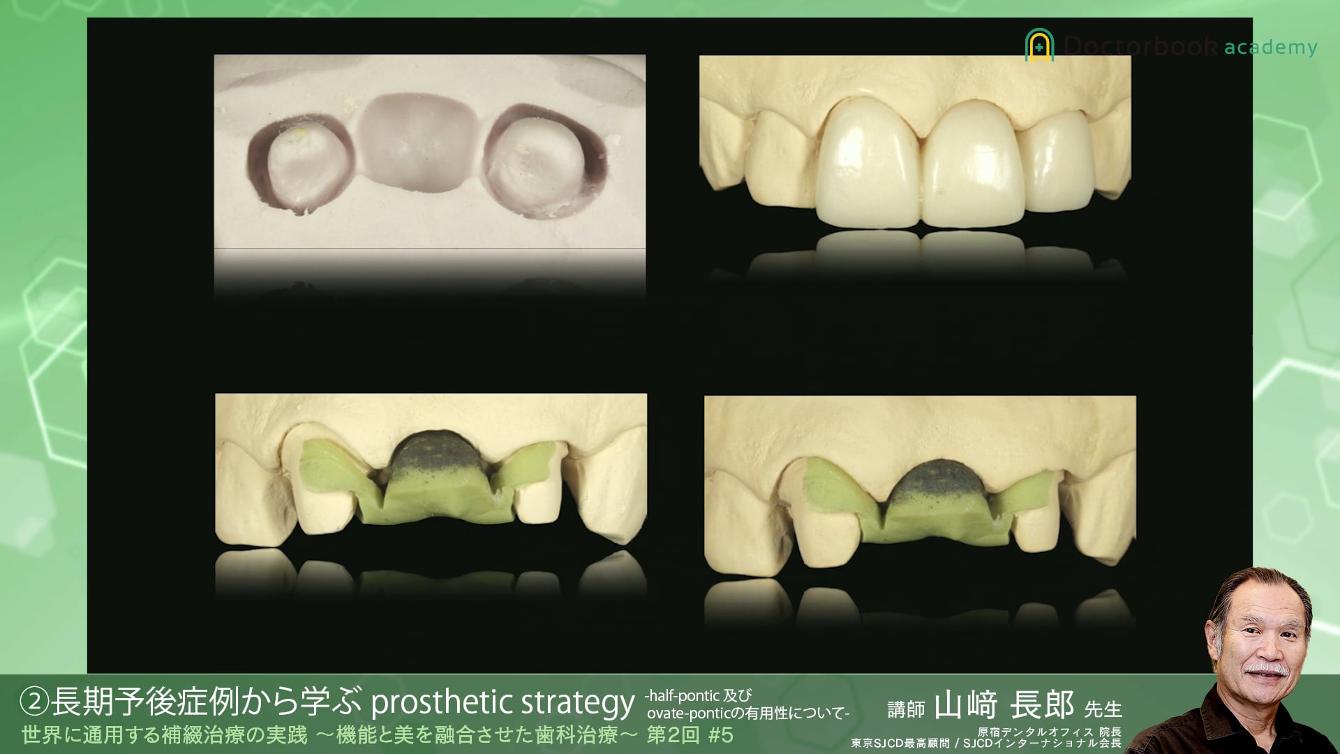 #5 長期予後症例から学ぶ prosthetic strategy -half-pontic 及び ovate-pontic の有用性について-