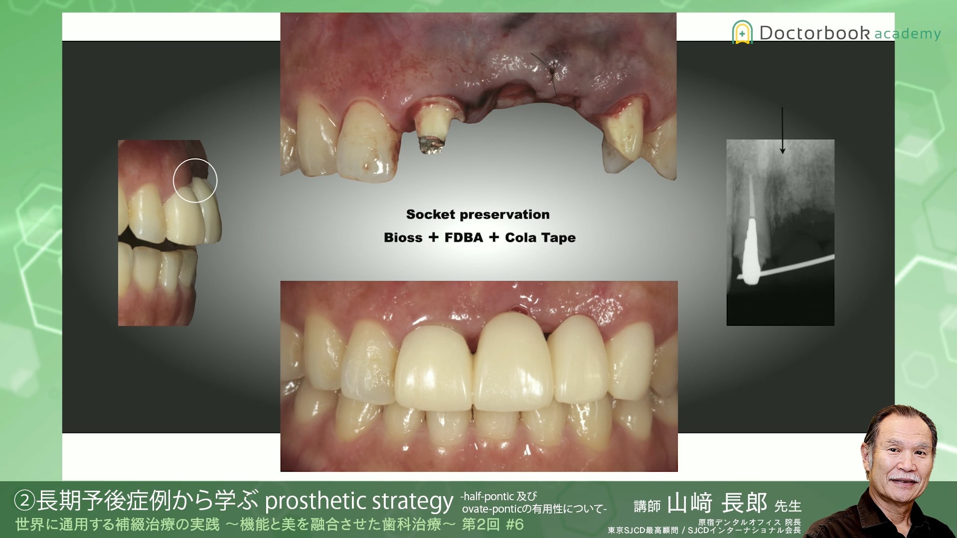 #6 長期予後症例から学ぶ prosthetic strategy -half-pontic 及び ovate-pontic の有用性について-