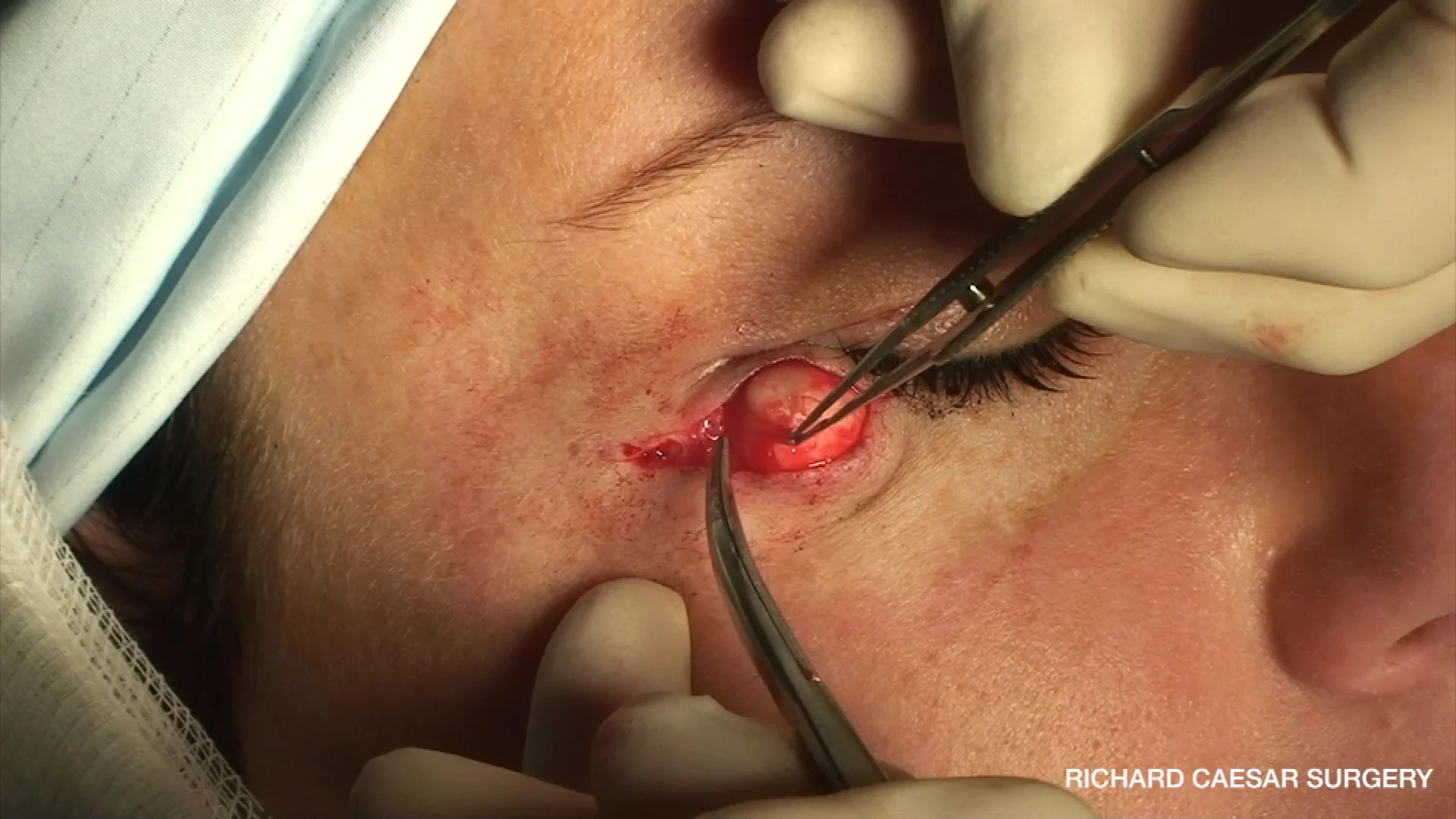 sebaceous cyst removal