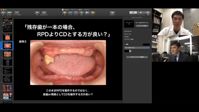 #1 Denture Cafe 第1回「残存歯が１本の場合、RPDよりCDとする方が良い？」