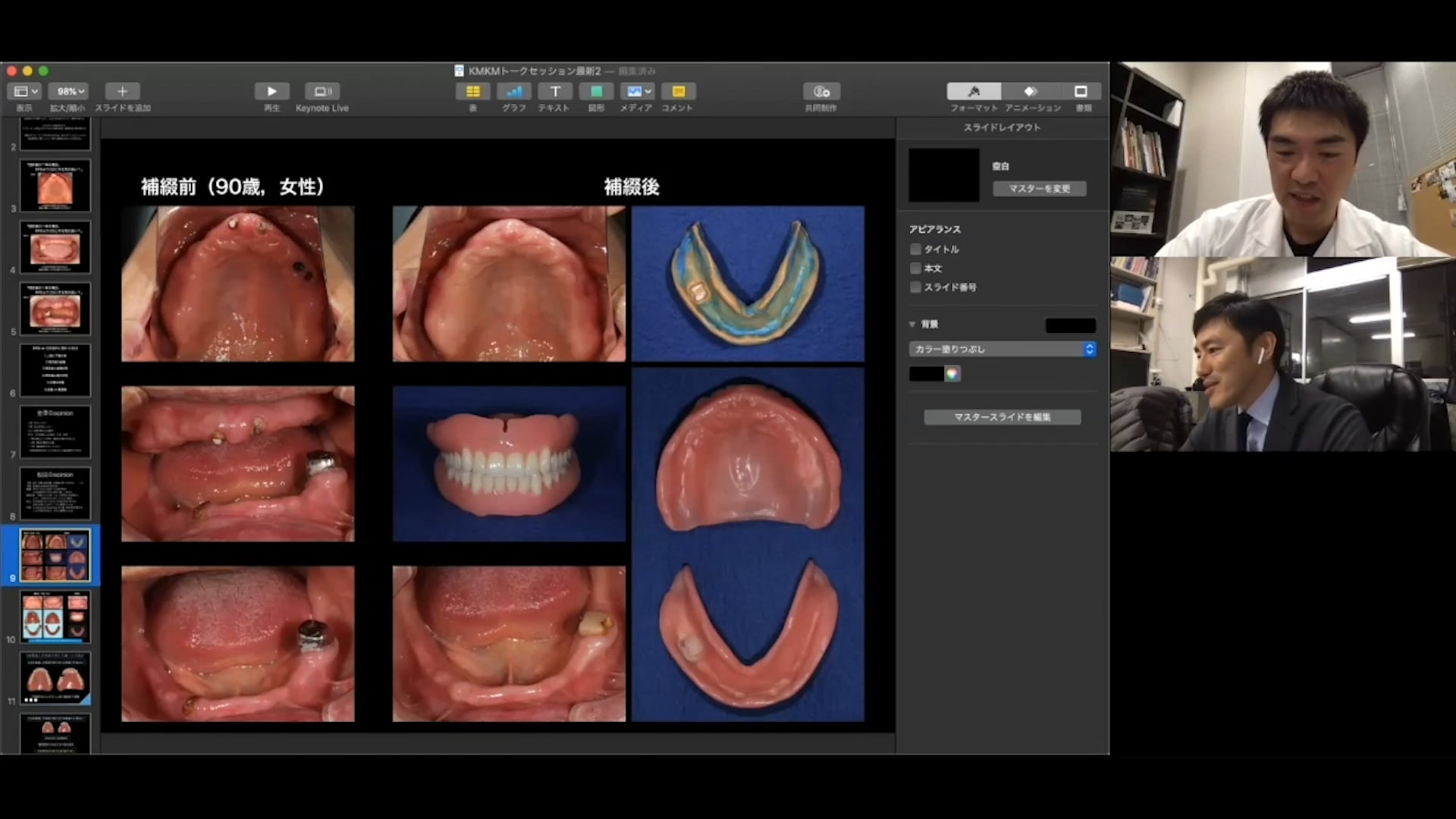 #3 Denture Cafe 第1回「残存歯が１本の場合、RPDよりCDとする方が良い？」