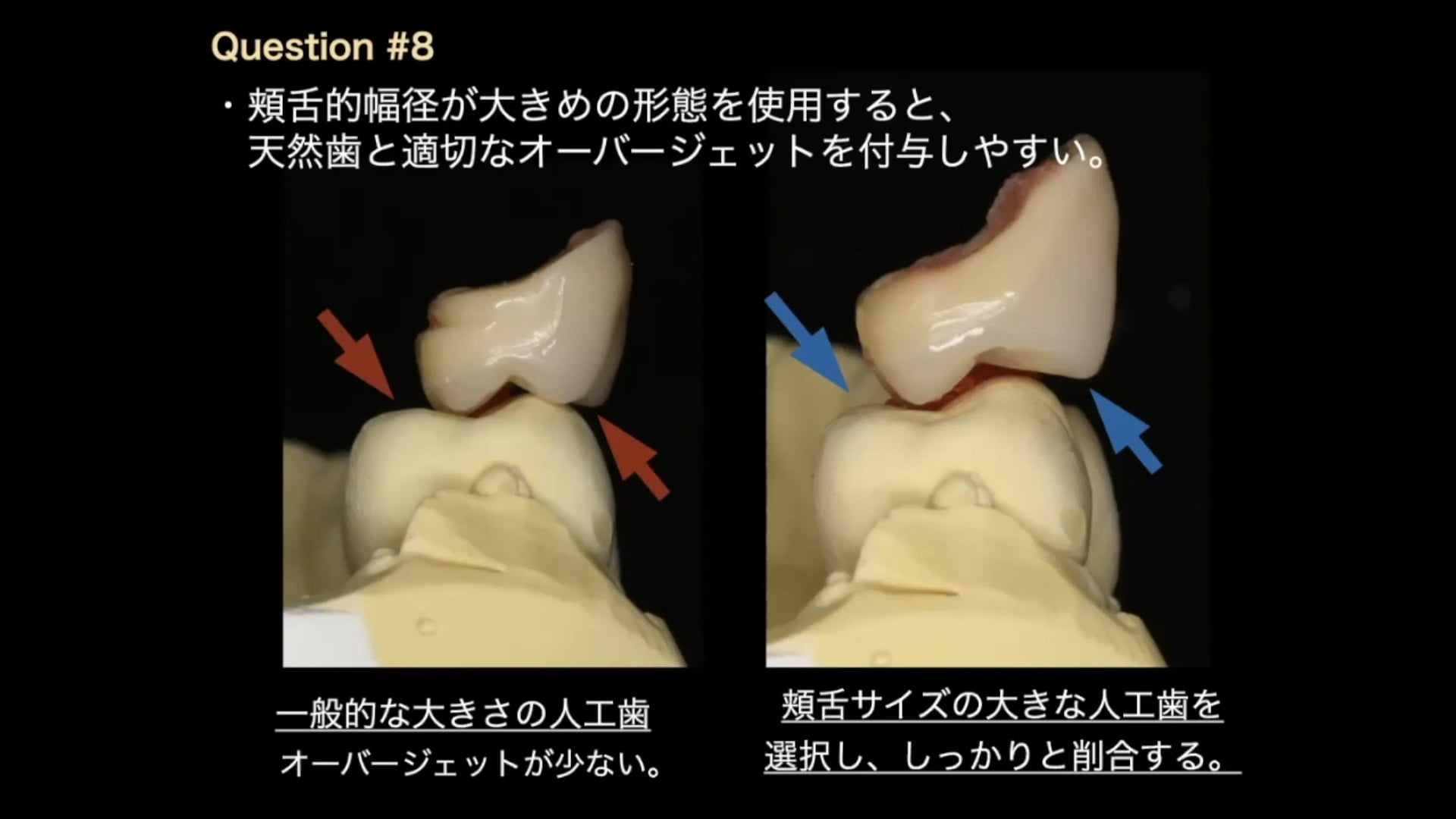 #2 Denture Cafe 第4回「義歯臨床のお悩み相談室」