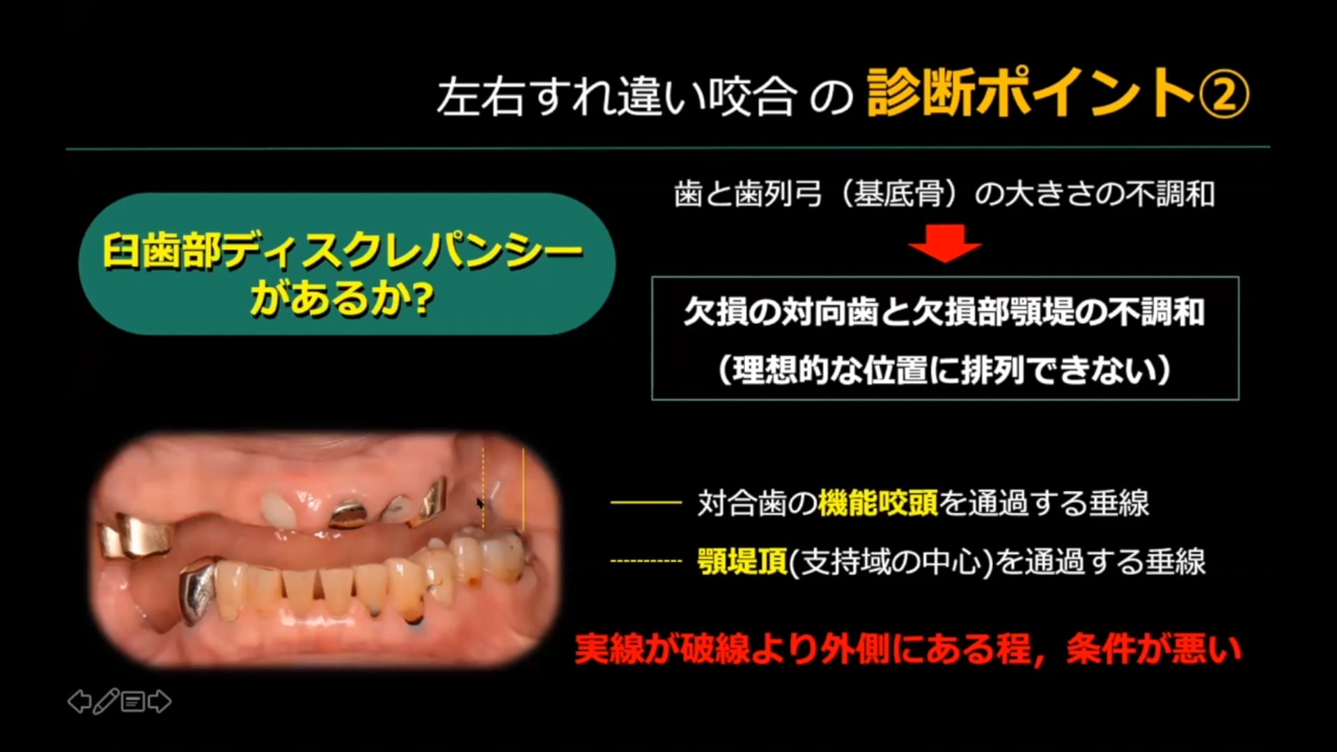 #1 Denture Cafe 第6回「左右すれ違い症例をどう考える？」