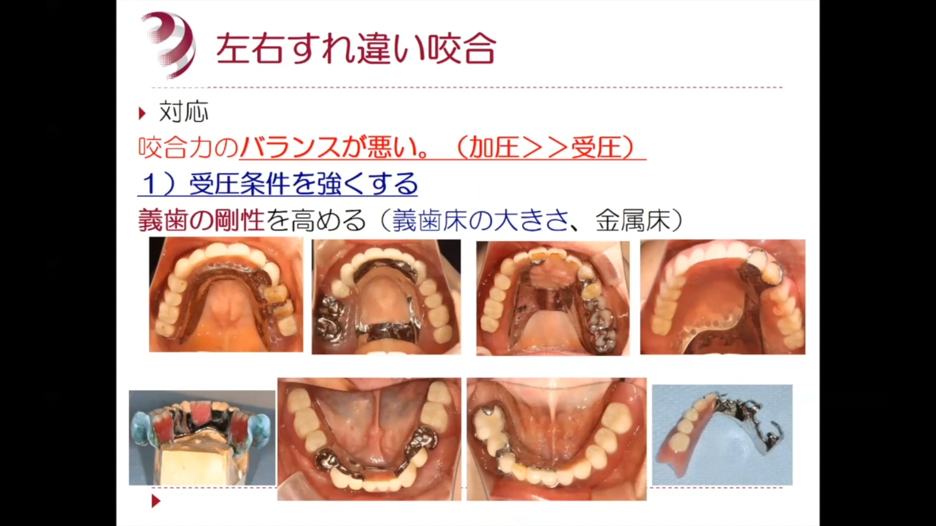 #2 Denture Cafe 第6回「左右すれ違い症例をどう考える？」