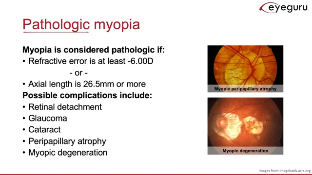 3.1: Myopia and Hyperopia