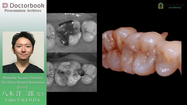 Minimally Invasive Dentistry The Direct Bonded Restoration