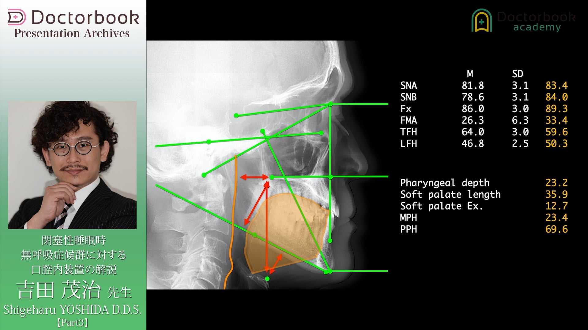 #3 Adjustable OA or Fixed OA