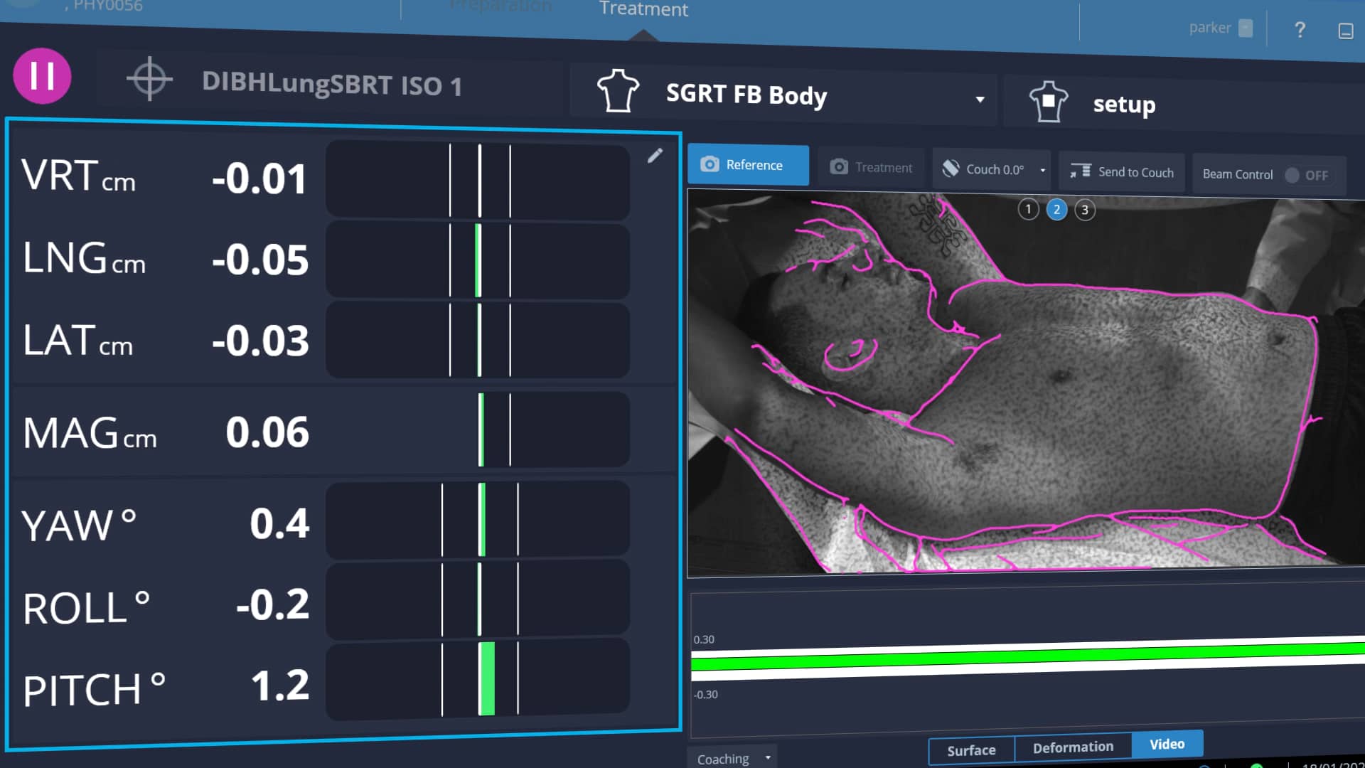 AlignRT Advance Breath Hold Overview on Vimeo