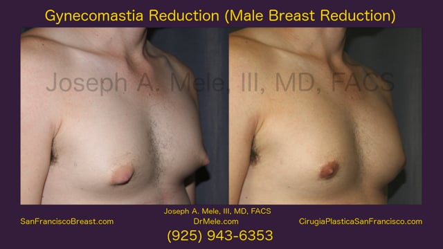 cheapest gynecomastia surgery near me