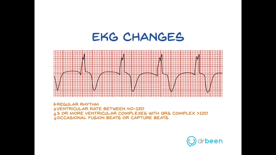 Accelerated Idioventricular Arrhythmia