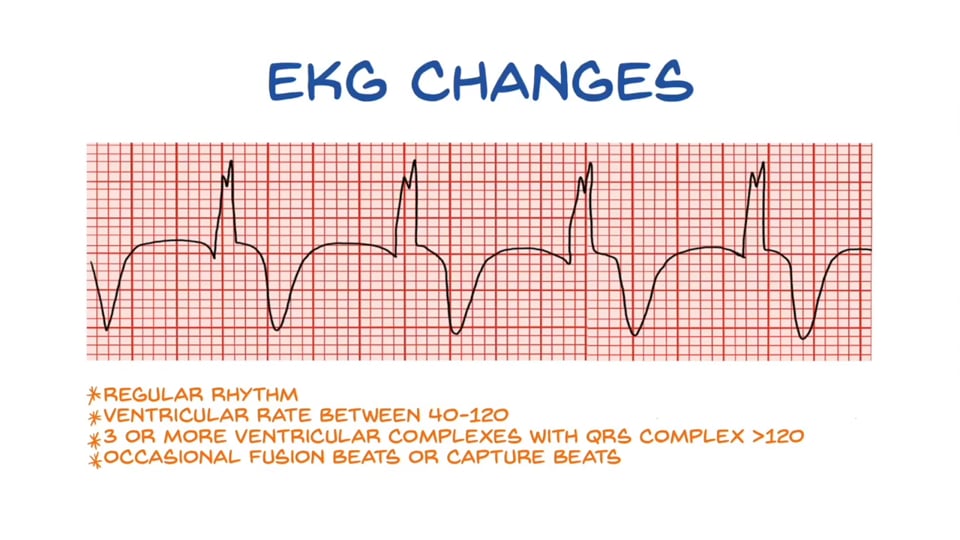 Accelerated Idioventricular Arrhythmia