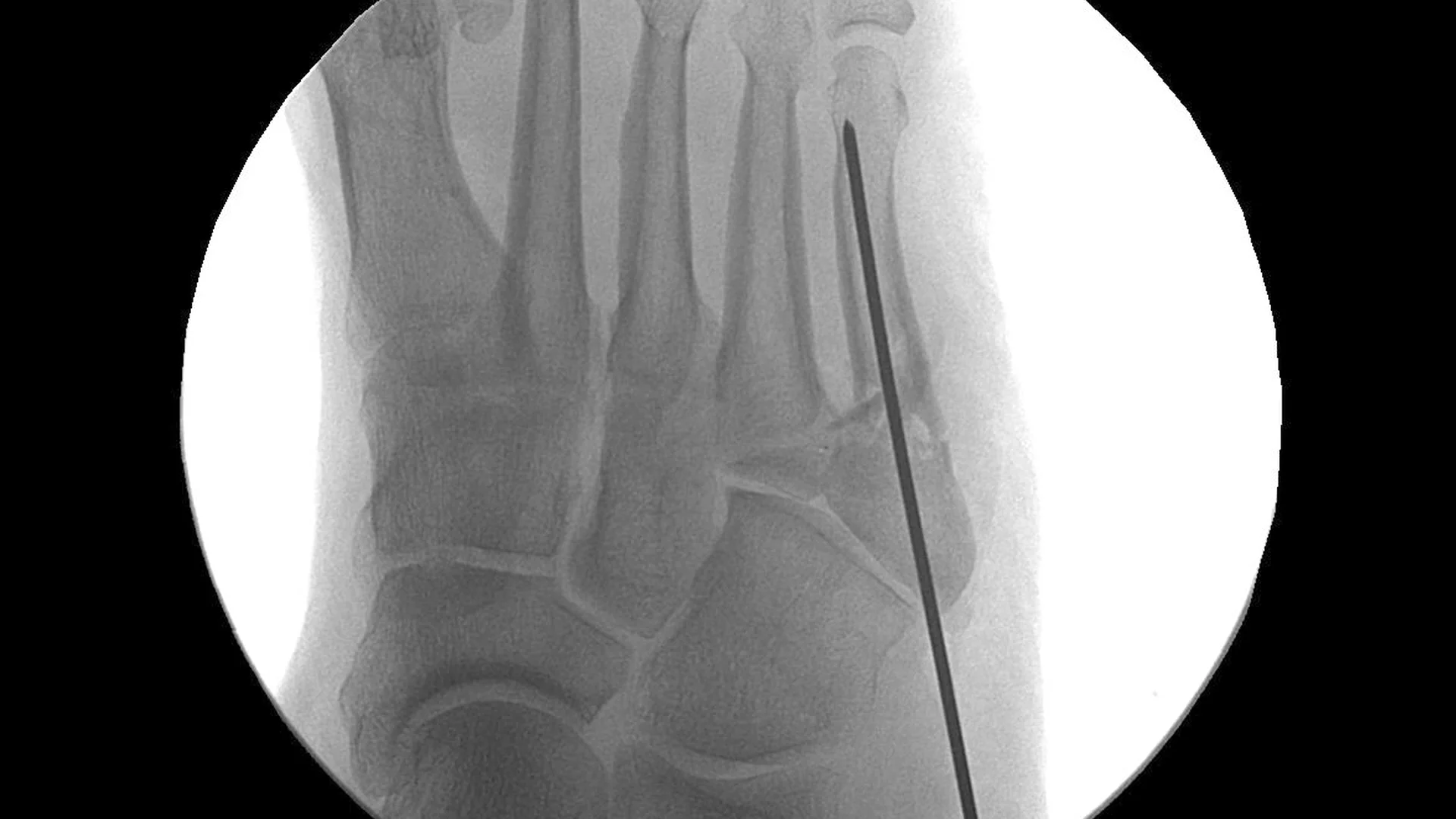 Audible disease FRACTURE FR-1 トレモロ Audible Disease :: Fracture FR-1