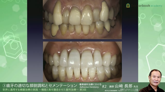 #9 歯牙の適切な顔貌調和とセメンテーション -審美歯科治療におけるAdhesive Dentistry-【12/05-12/11 プレミアム化】