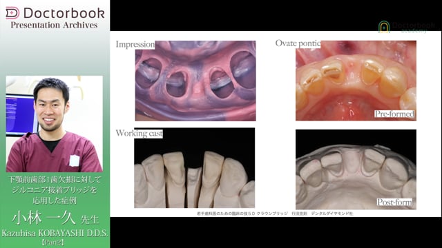 #2 How to bond Ziruconia