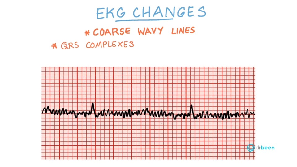 Ventricular Fibrillation (V-Fib)