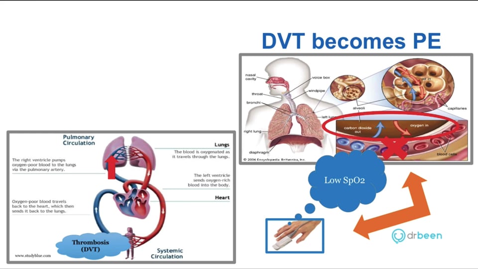 Pulmonary Embolism - Definition, Pathophysiology, and Presentation