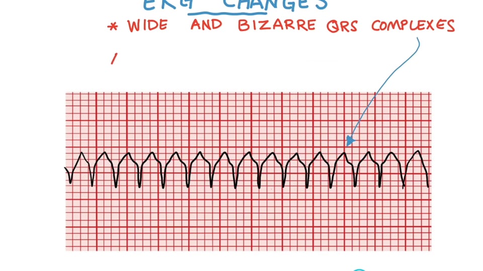 Ventricular Tachycardia