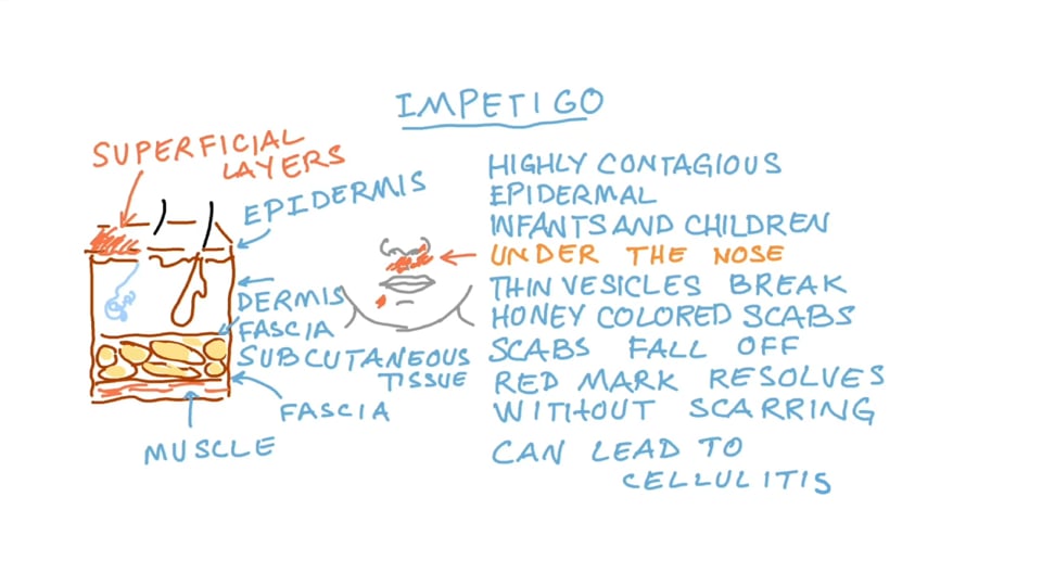 Staphylococcus Skin Infections Impetigo Folliculitis Furuncles or Boils Carbuncles Cellulitis Surgical Wound