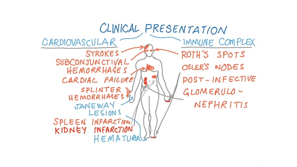 Staphylococcus - Diagnosing Acute Infective Endocarditis (Modified Duke's Criteria)