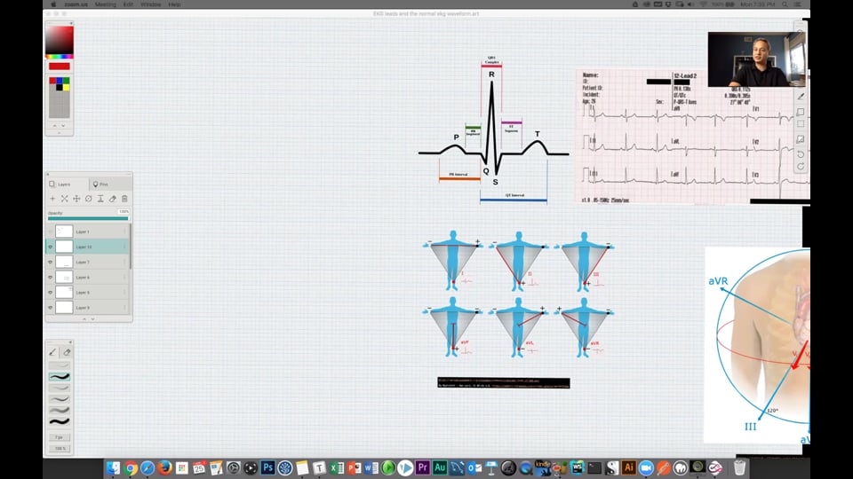 (Webinar) EKG Leads and Normal Waveform