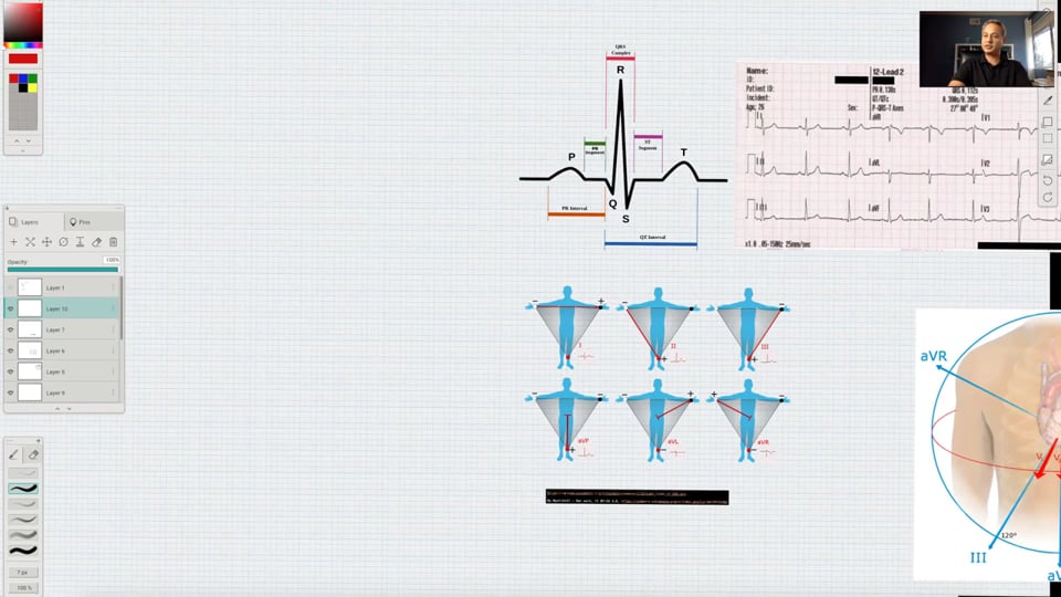 (Webinar) EKG Leads and Normal Waveform