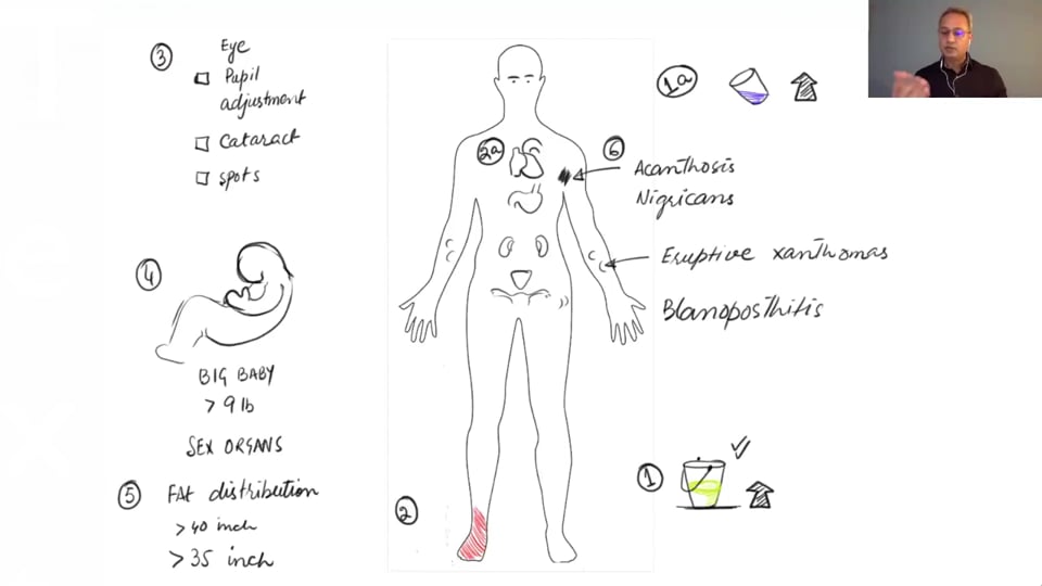 Clinical Presentation of Type II Diabetes Mellitus (Managing Type II Diabetes Mellitus -  Part 5. Webinar)