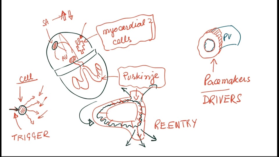 Focal Atrial Tachycardia (Paroxysmal Atrial Tachycardia)