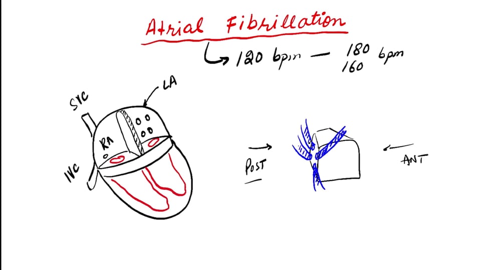 Atrial Fibrillation