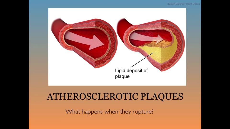 Ischemic Heart Disease: Clinical Presentation