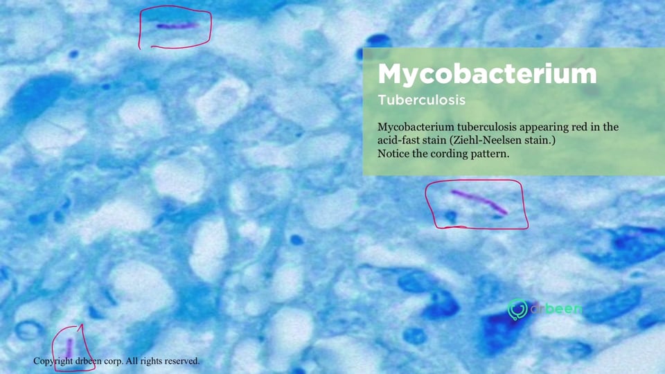 Primary Tuberculosis