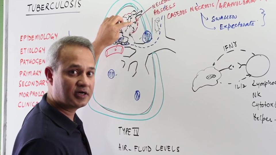 Secondary Tuberculosis