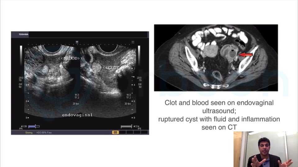 EMERGENCY SURGERY RUPTURED OVARIAN CYST & INTERNAL BLEEDING