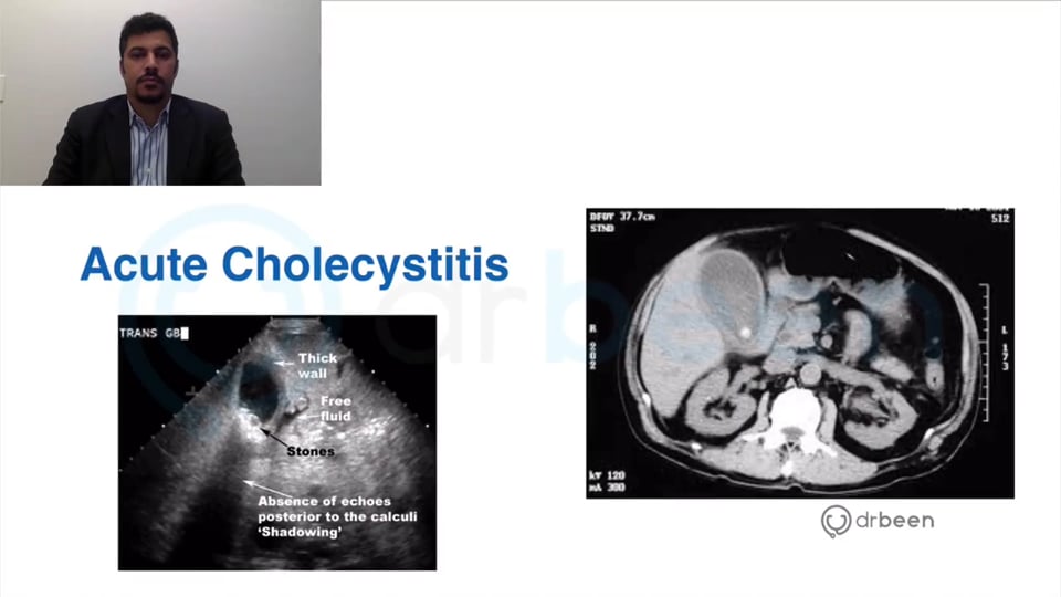 Cholecystitis