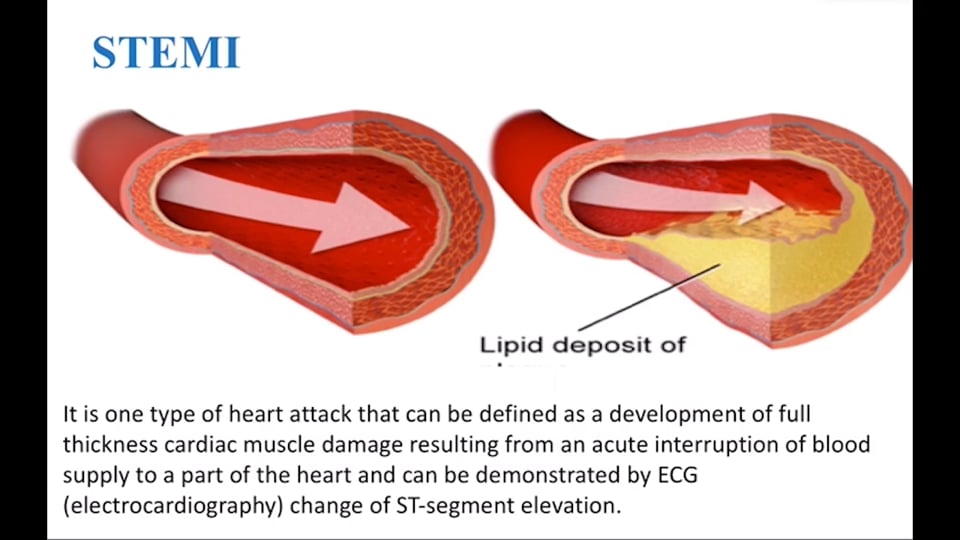 Ischemic Heart Disease (STEMI)