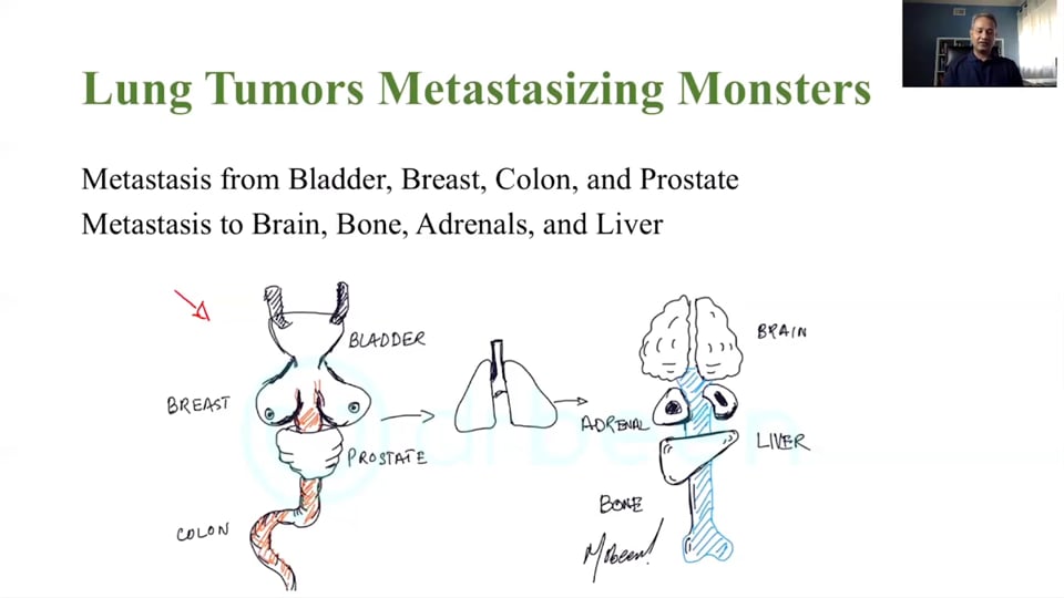 Tumors of the Lungs