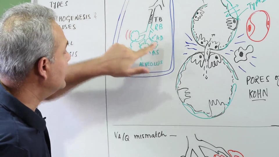 Pulmonary Atelectasis