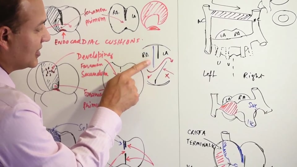 Atrial Development and Defects