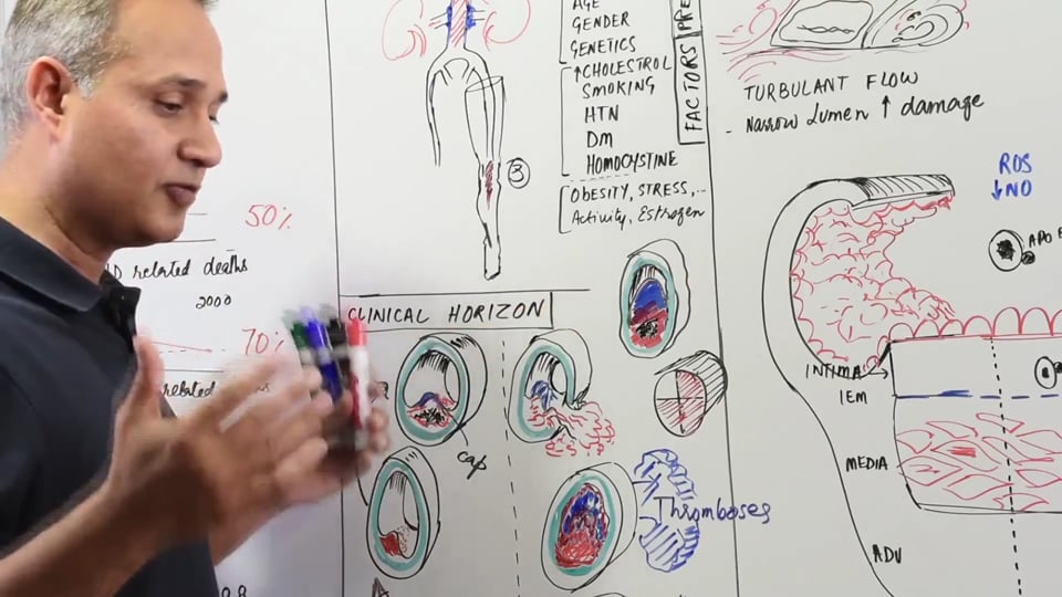 Atherosclerosis Progression - Clinical Horizon