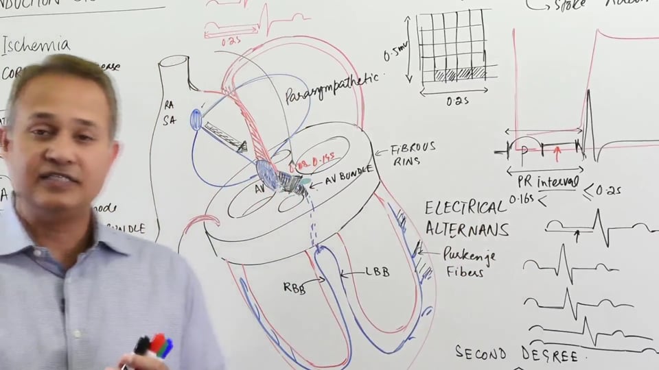 Electrical Alternans Purkinje Blocks