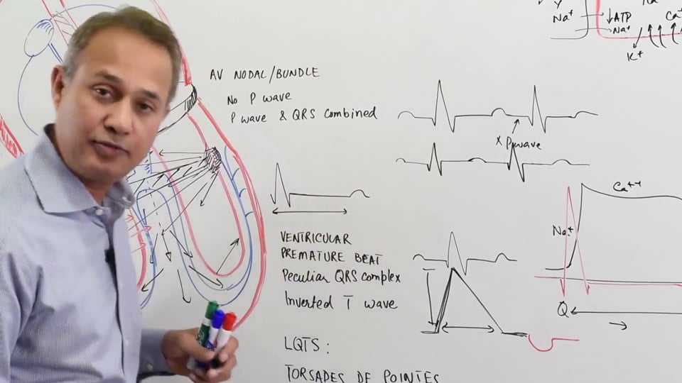 Premature Ventricular Beats Torsades  De Pointes