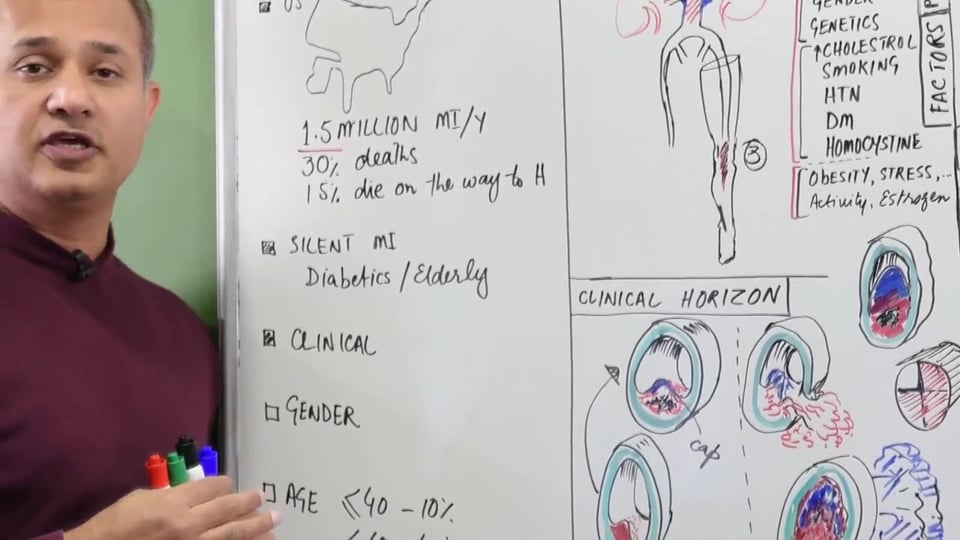 Myocardial Infarction (MI) - Pathophysiology