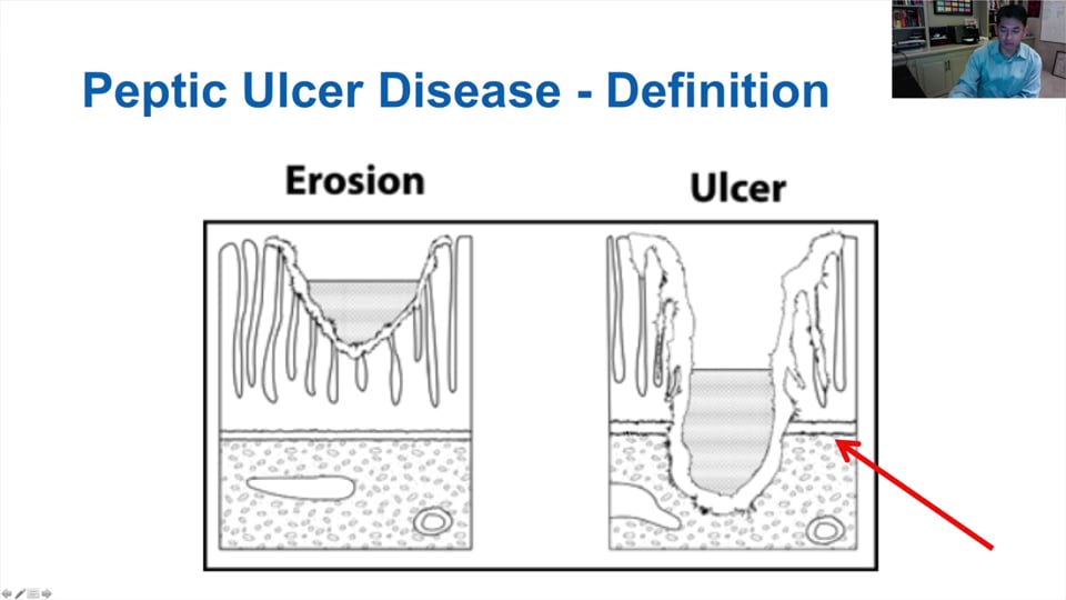 Peptic Ulcer Disease