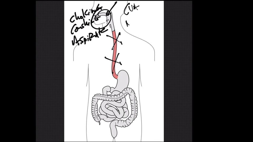 Oropharyngeal Dysphagia