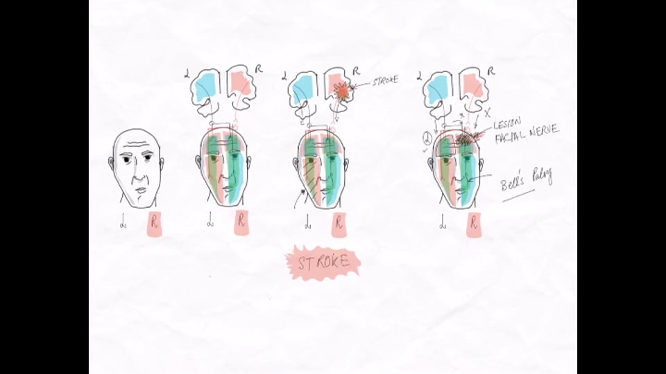 Stroke vs. Bell's Palsy: Key Distinguishing Factors