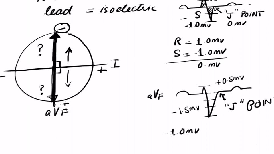 Cardiac Axis Using Isoelectric Lead Method