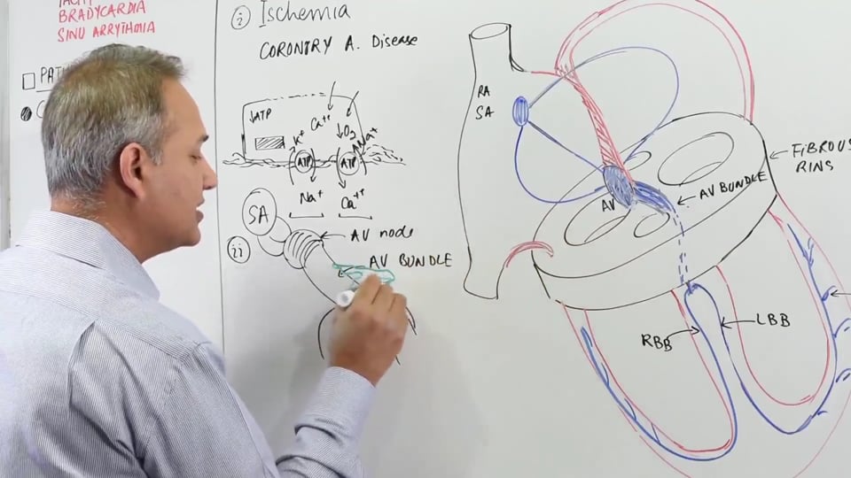 Sinoatrial Nodal Block (SA Nodal Block)