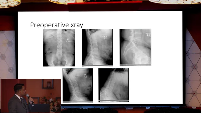 What is Lumbar Spine Degenerative Disc Disease & How to Manage? - Upswing  Health